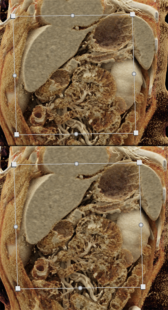 Pancreatic Cancer Imaging