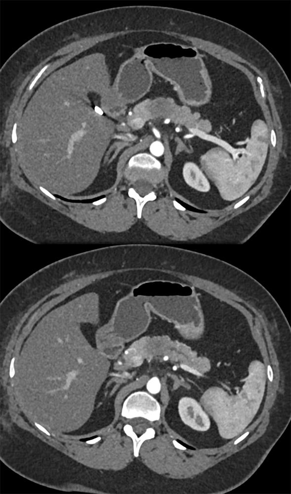 Adenocarcinoma of the Pancreas