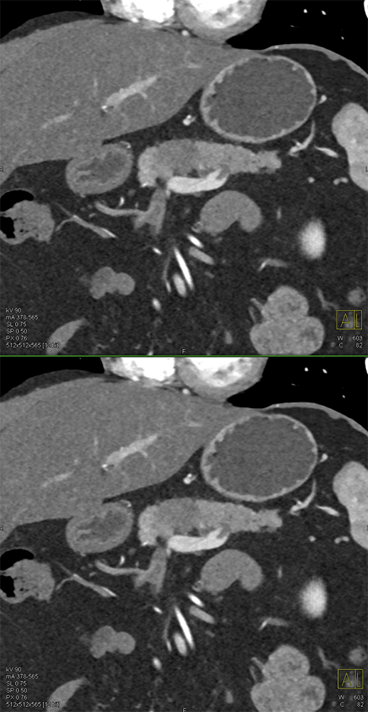 Pancreatic Cancer Imaging