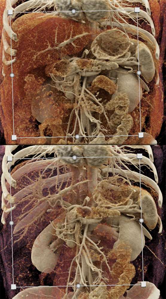 Pancreatic Cancer Imaging