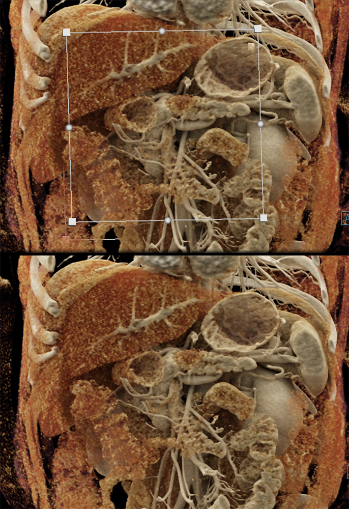 Pancreatic Cancer Imaging