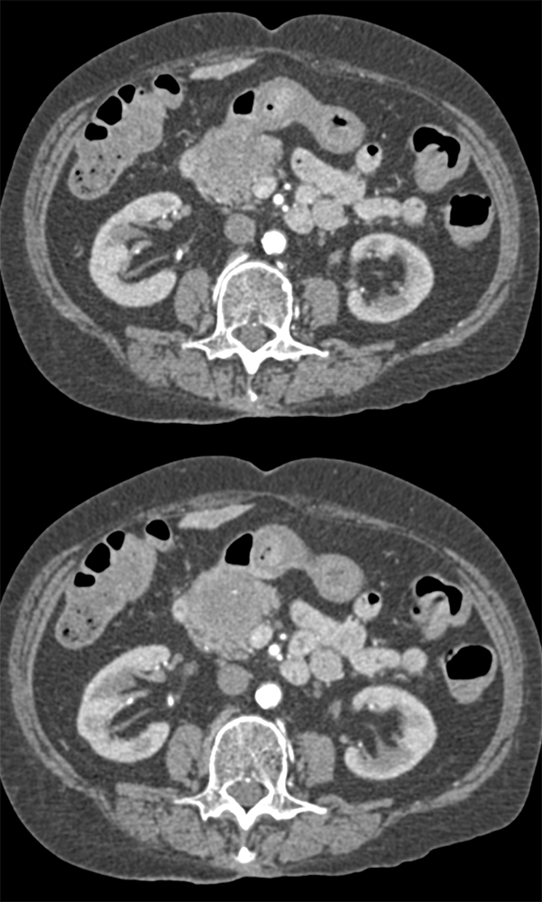 Adenocarcinoma HOP with Signet Ring Features