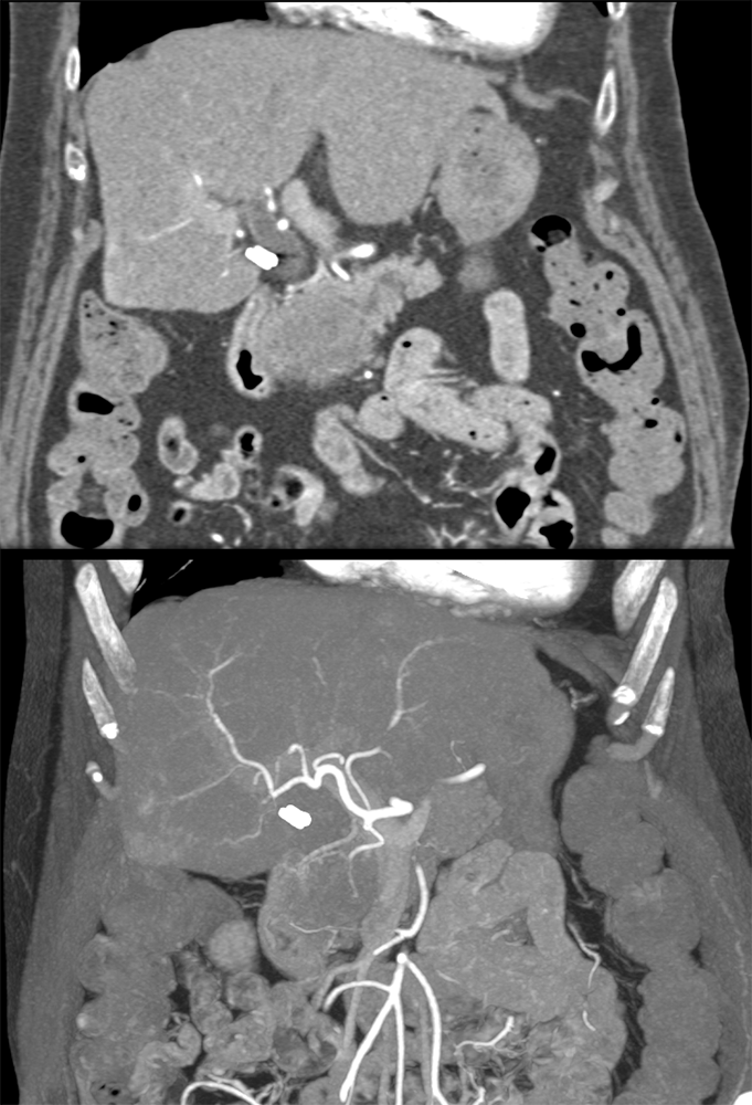 Pancreatic Cancer Imaging