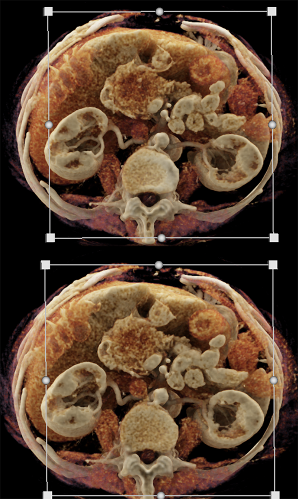 Pancreatic Cancer Imaging