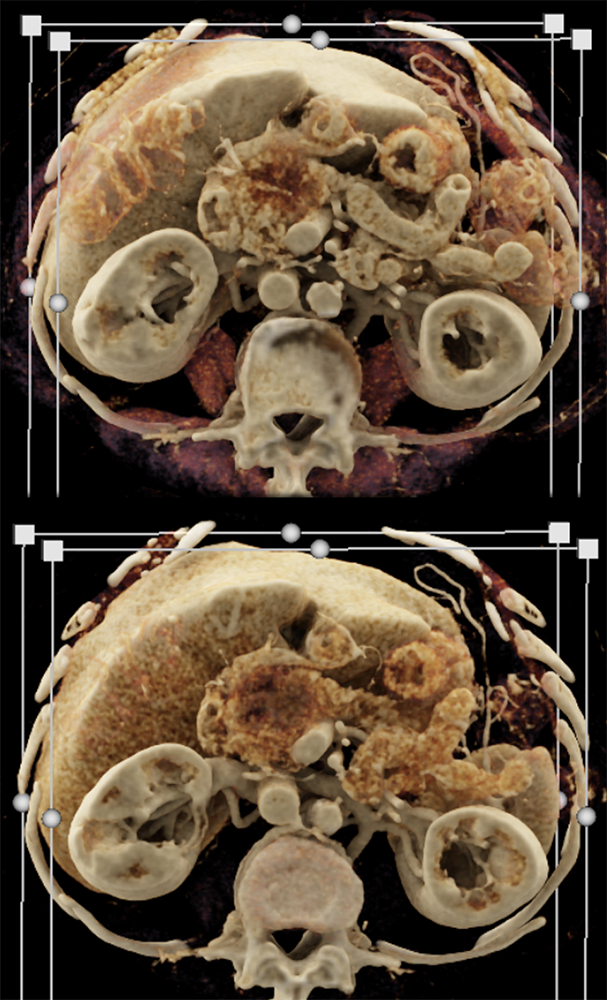 Pancreatic Cancer Imaging