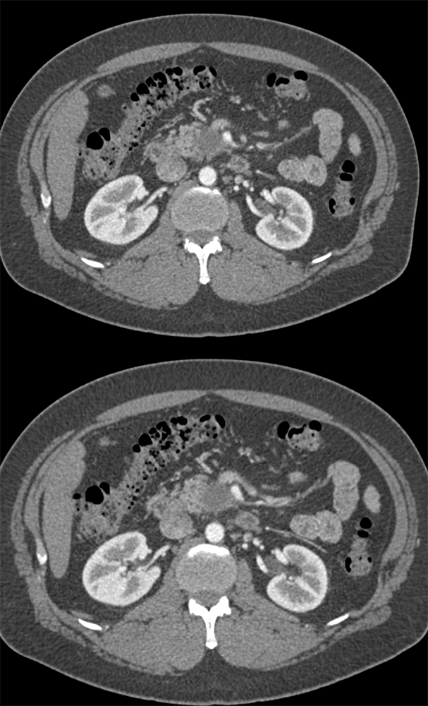 Adenocarcinoma Uncinate Mass