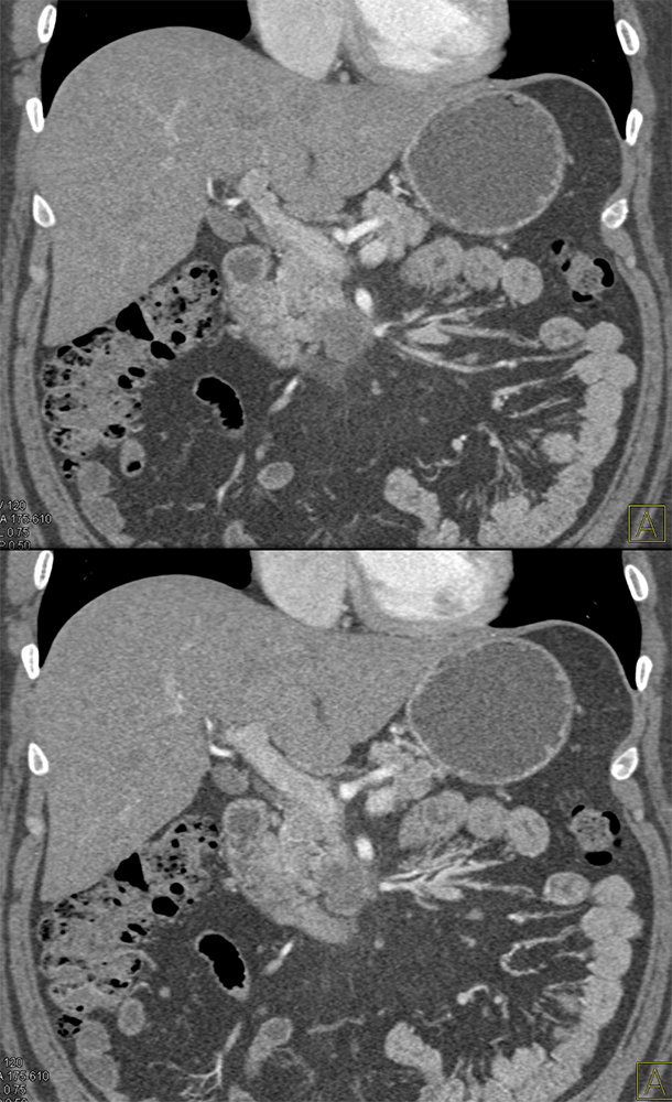 Pancreatic Cancer Imaging