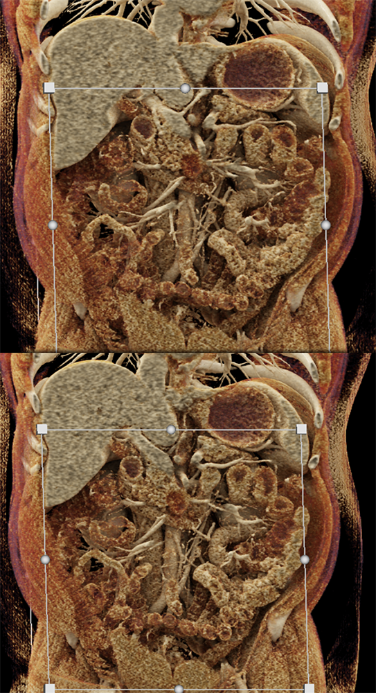 Pancreatic Cancer Imaging