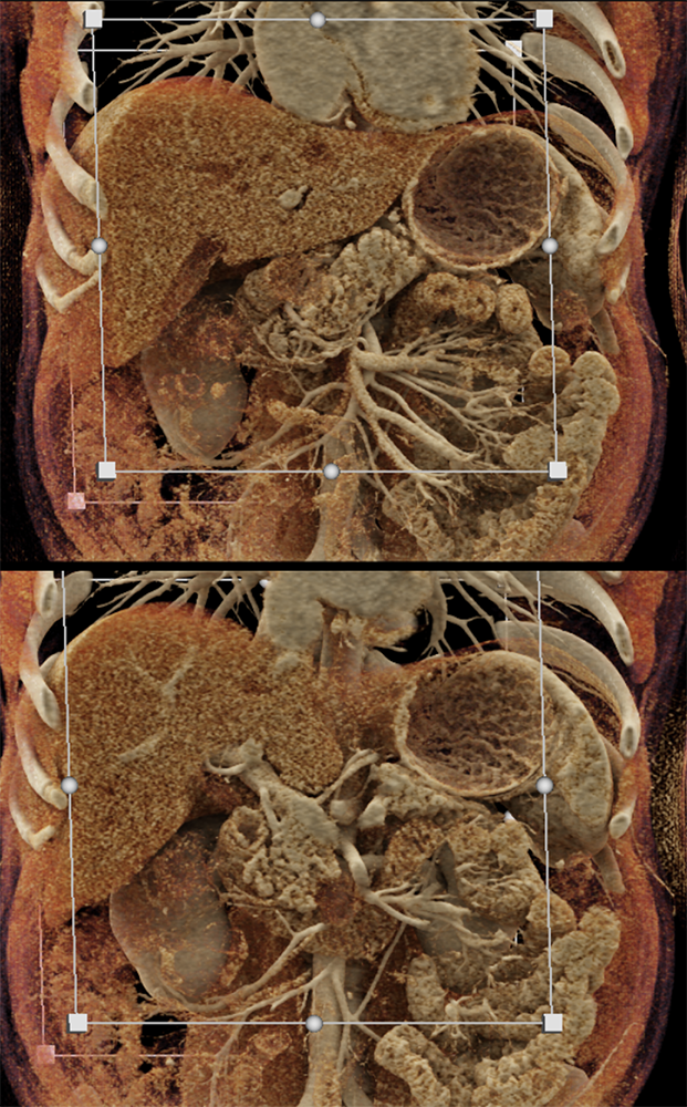 Pancreatic Cancer Imaging