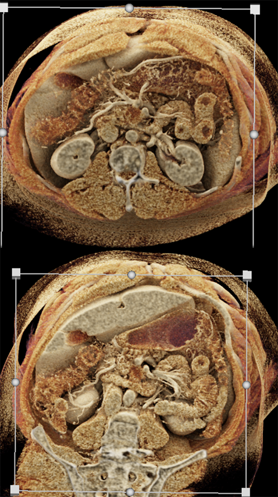 Pancreatic Cancer Imaging