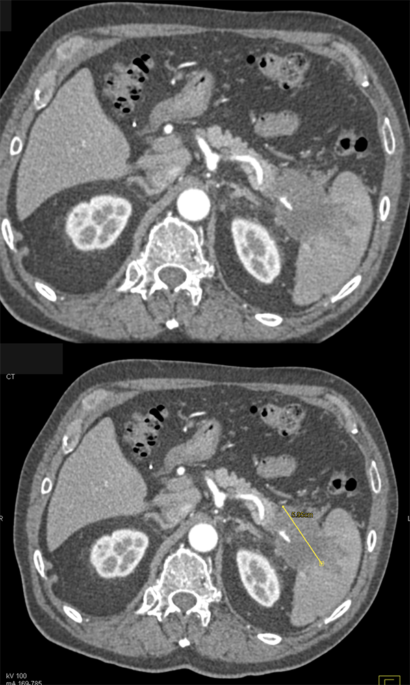 Carcinoma Tail of Pancreas Involves the Spleen