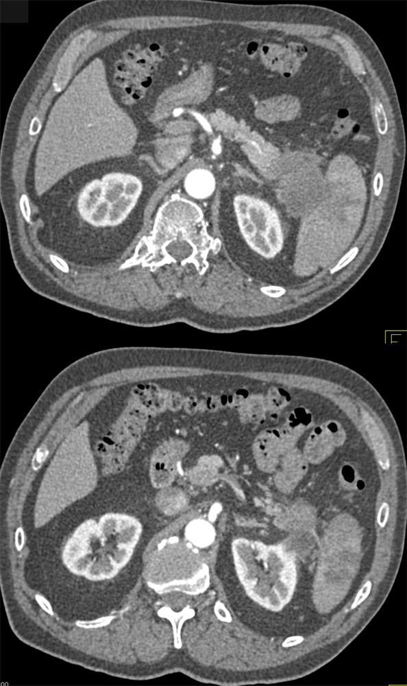 Pancreatic Cancer Imaging