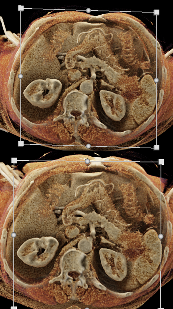 Pancreatic Cancer Imaging