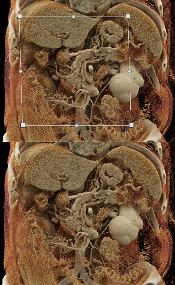 Pancreatic Cancer Imaging