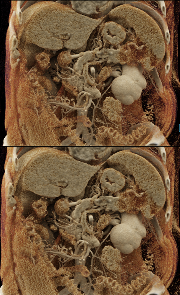 Pancreatic Cancer Imaging