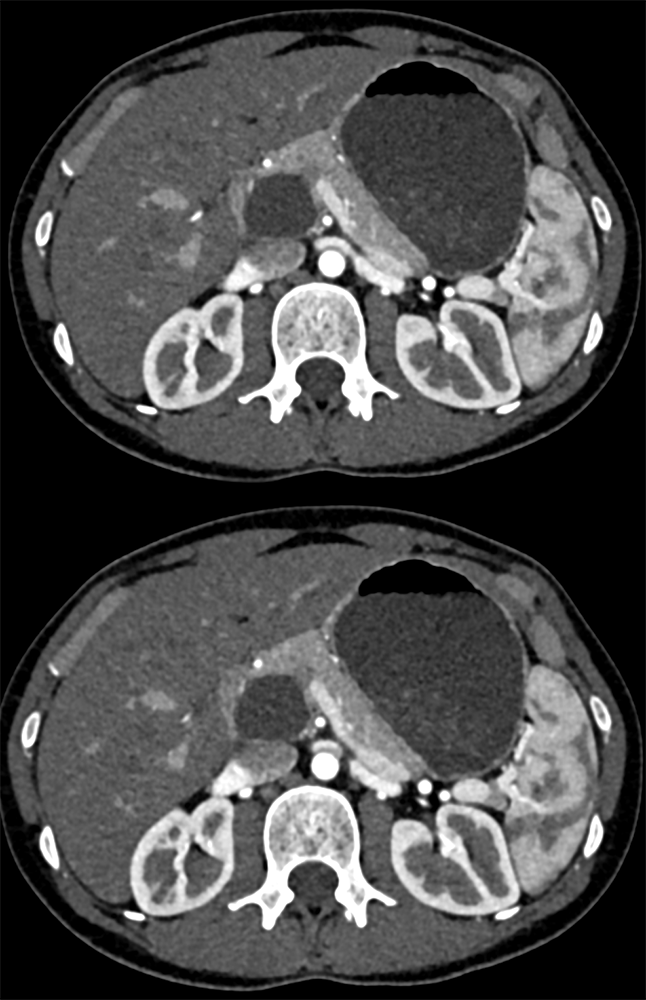 Pancreatic Cysts-IPMN