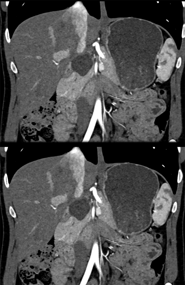 Pancreatic Cancer Imaging