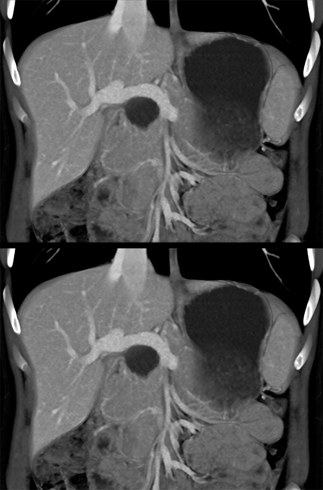 Pancreatic Cancer Imaging