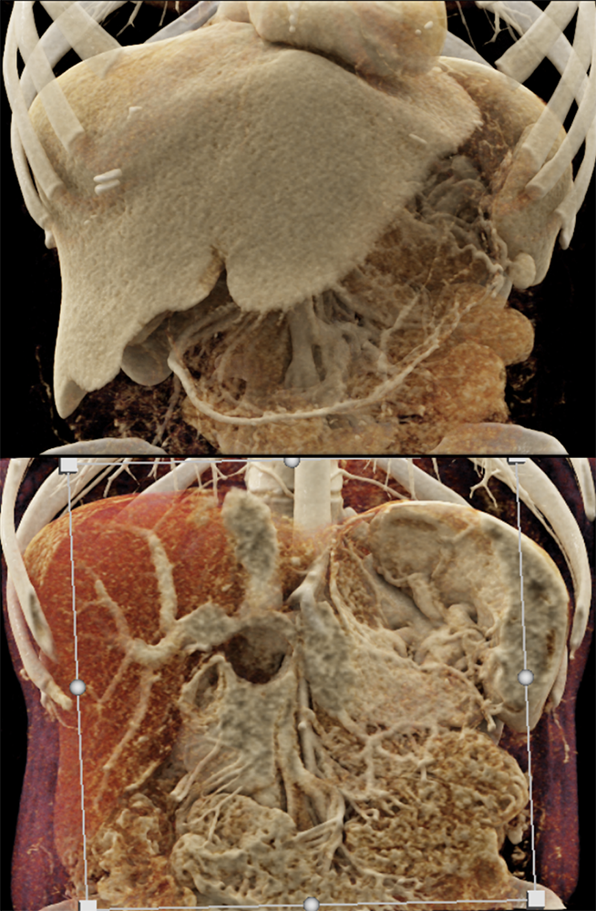 Pancreatic Cancer Imaging