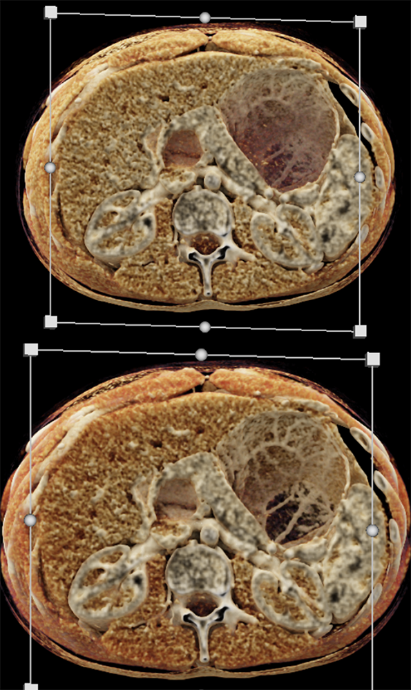 Pancreatic Cancer Imaging