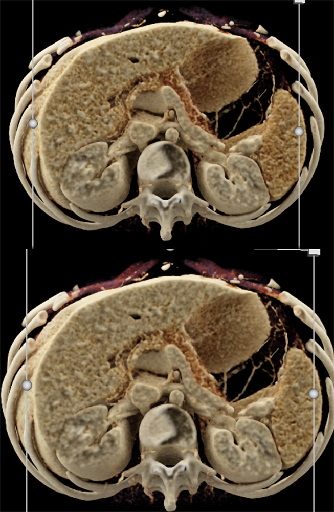 Pancreatic Cancer Imaging