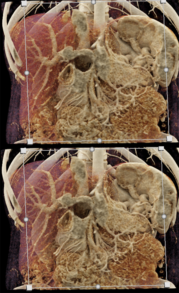 Pancreatic Cancer Imaging