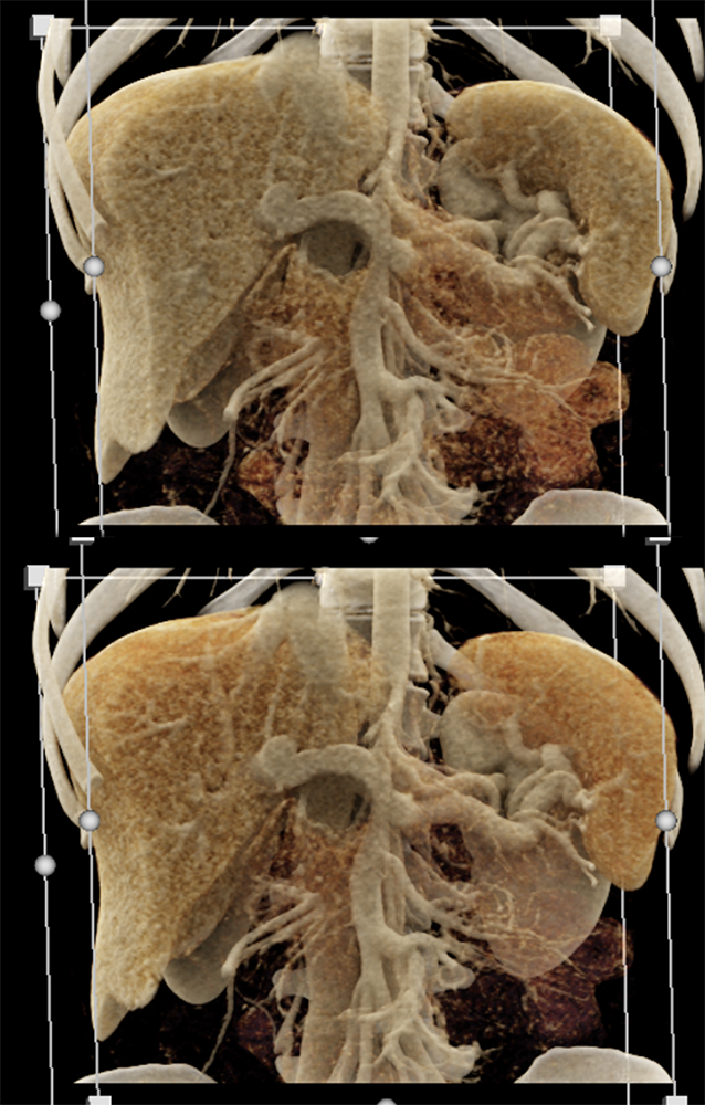 Pancreatic Cancer Imaging