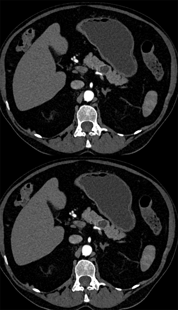 1.8 cm PNET Cystic Body of the Pancreas