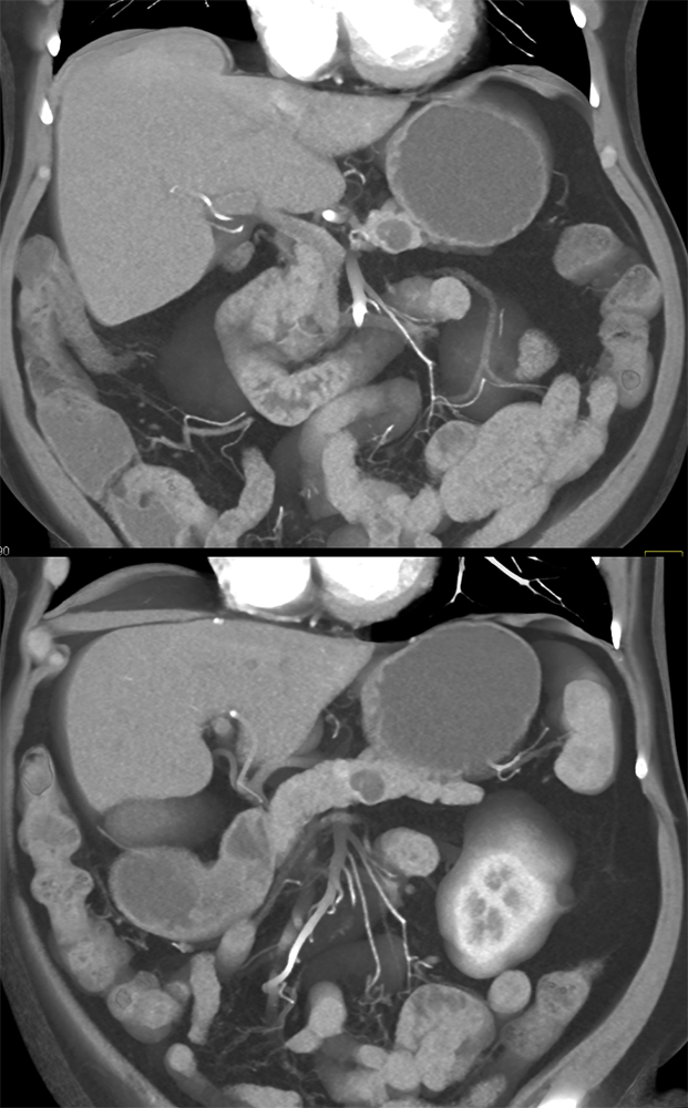 Pancreatic Cancer Imaging