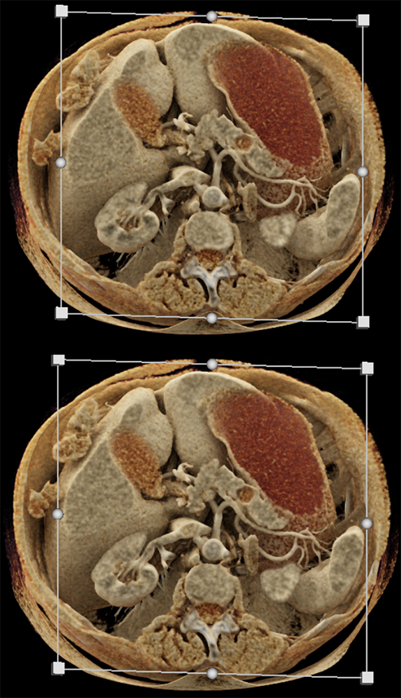 Pancreatic Cancer Imaging