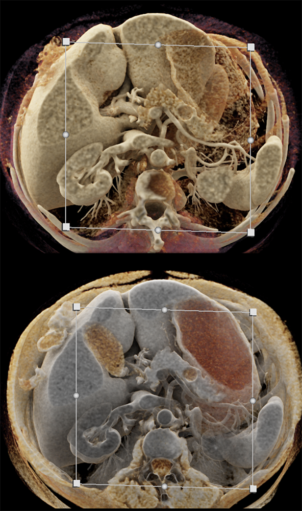 Pancreatic Cancer Imaging