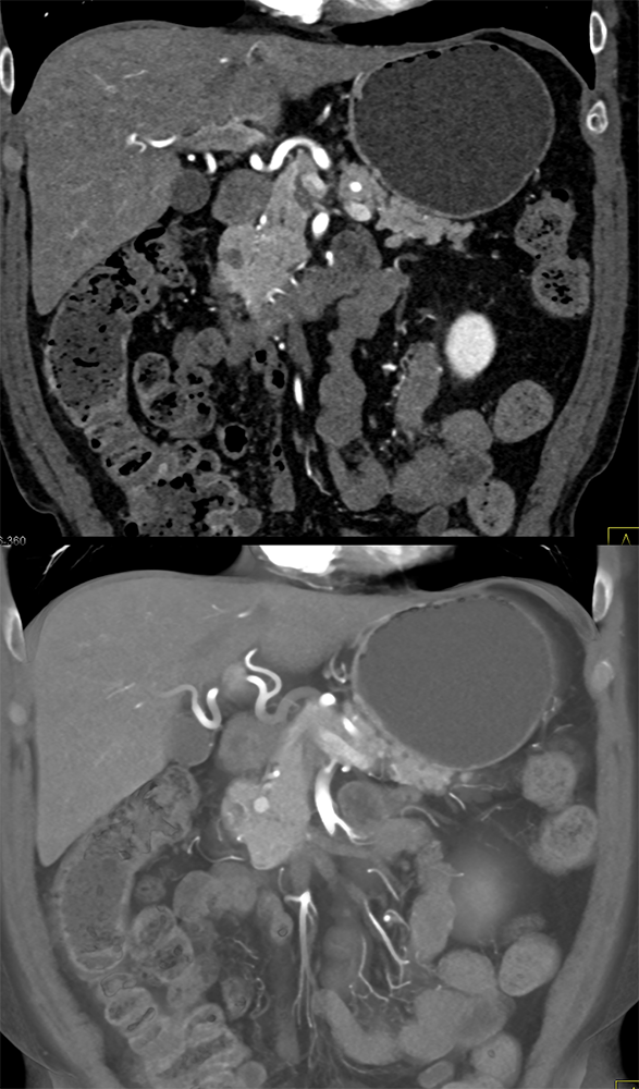 Pancreatic Cancer Imaging