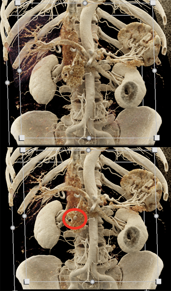 Pancreatic Cancer Imaging