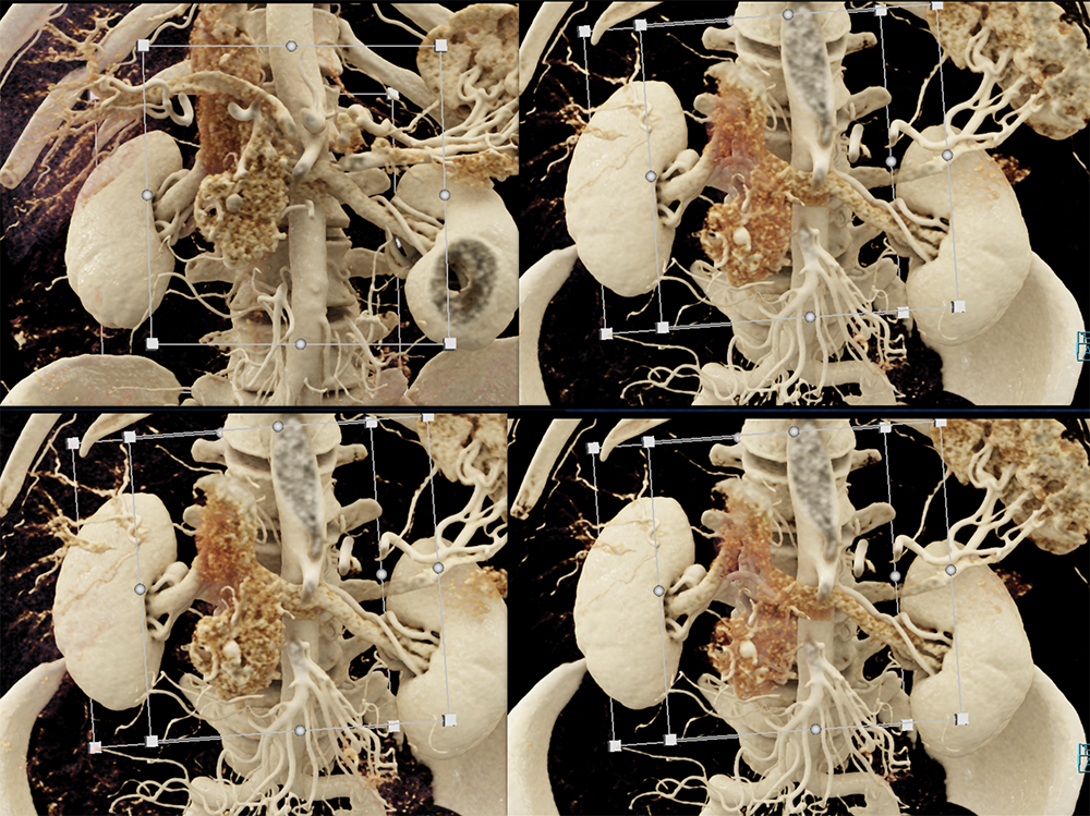 Pancreatic Cancer Imaging