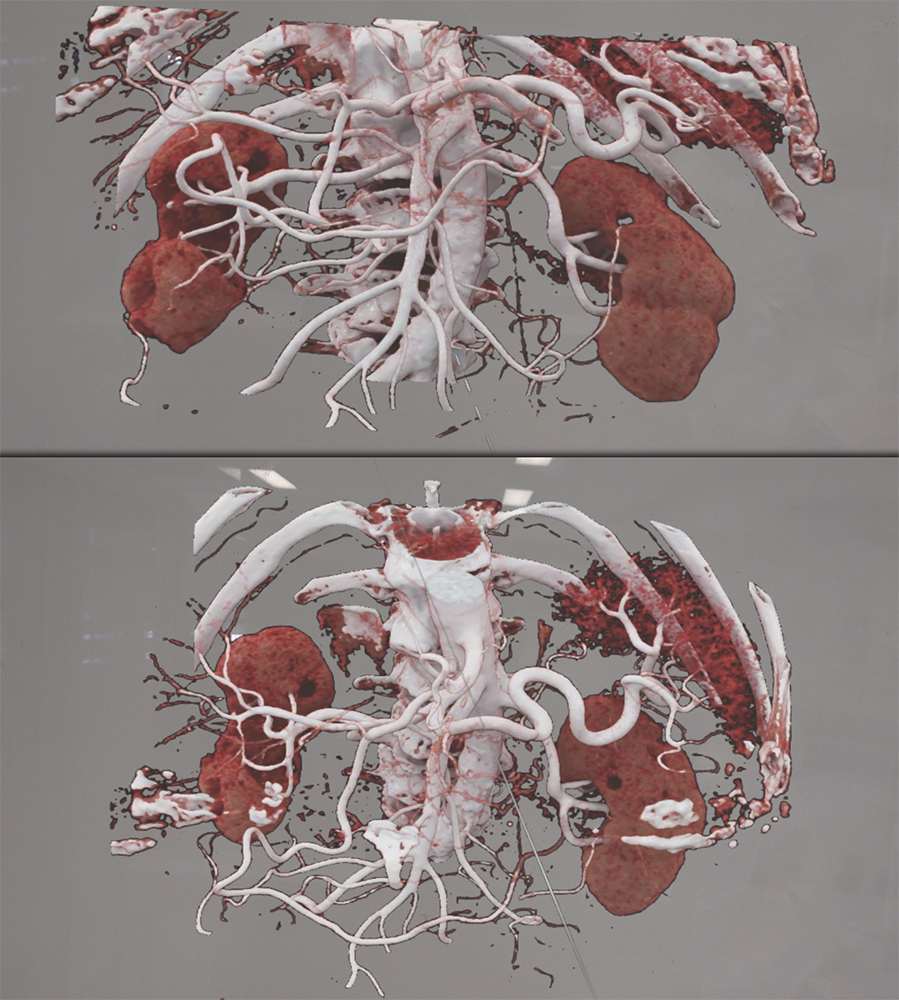 Pancreatic Cancer Imaging