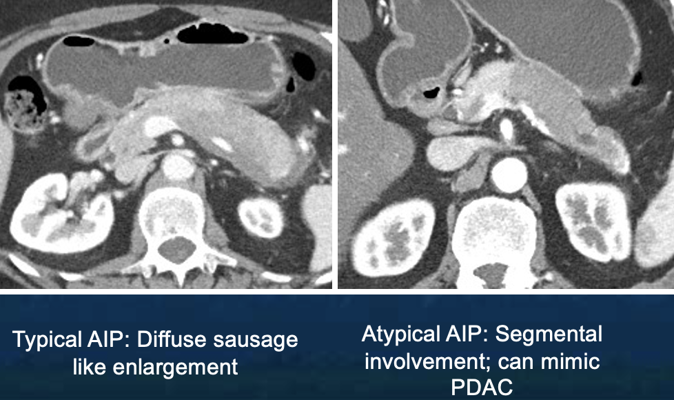 Pancreatic Cancer Imaging