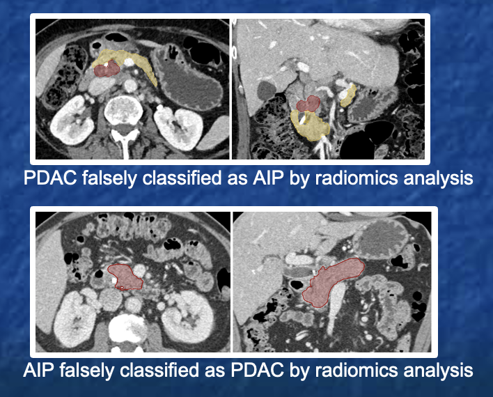 Pancreatic Cancer Imaging