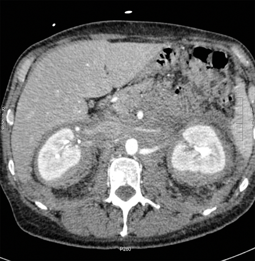 CT of the Perirenal Space