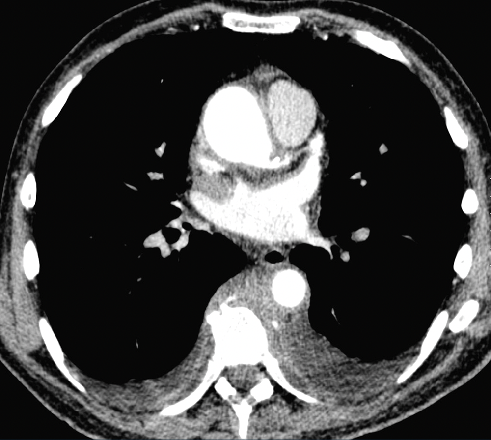 CT of the Perirenal Space