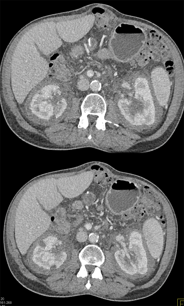 CT of the Perirenal Space