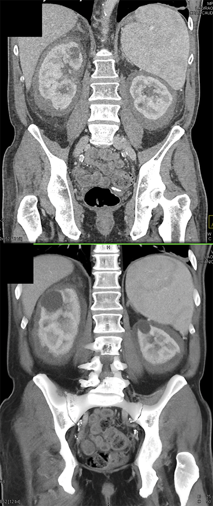 CT of the Perirenal Space