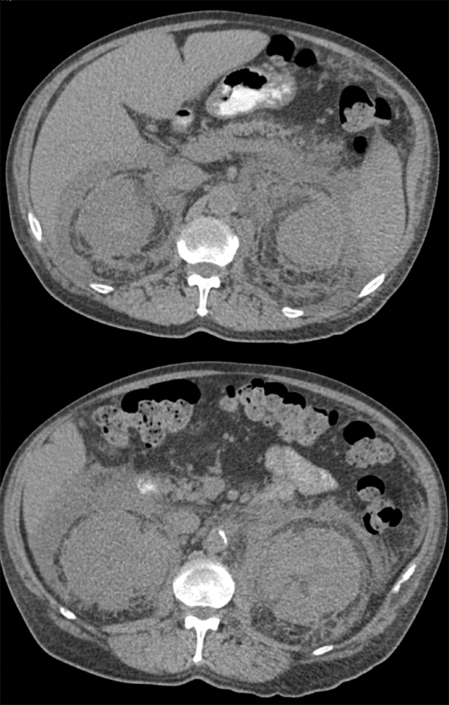 Erdheim Chester Disease