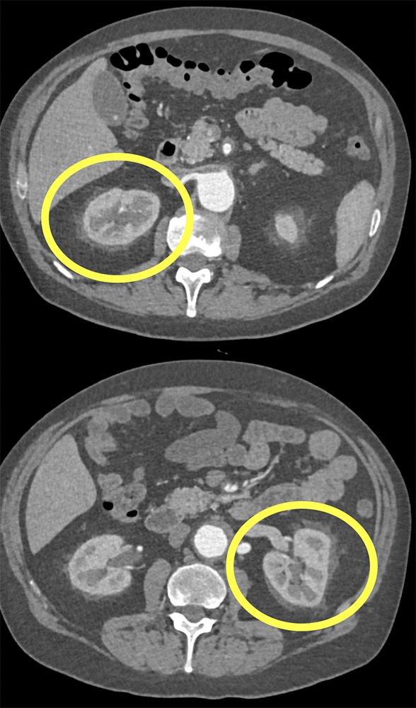 Ernheim Chester Disease