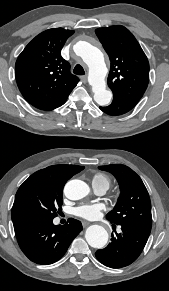 CT of the Perirenal Space