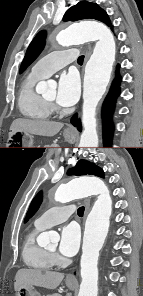 CT of the Perirenal Space