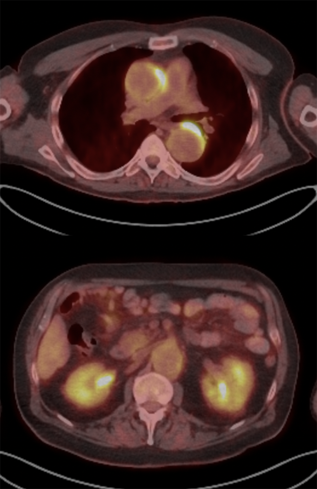 CT of the Perirenal Space