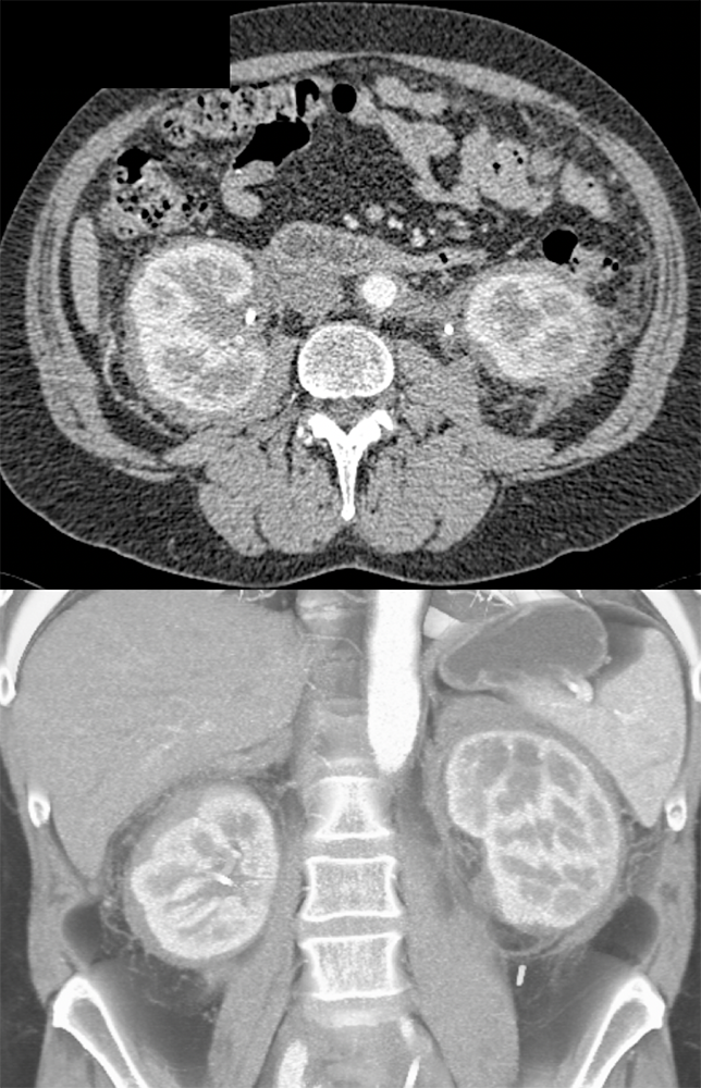 Retroperitoneal Fibrosis