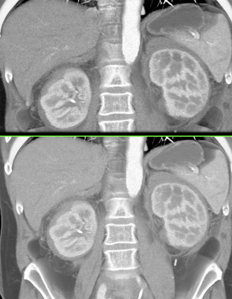 CT of the Perirenal Space