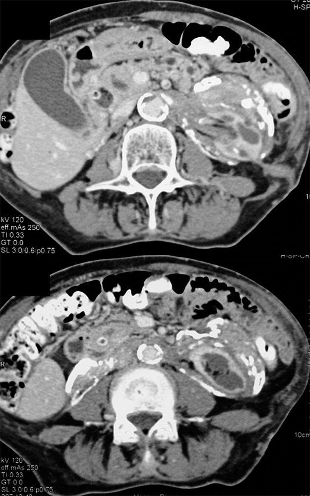 Retroperitoneal fibrosis