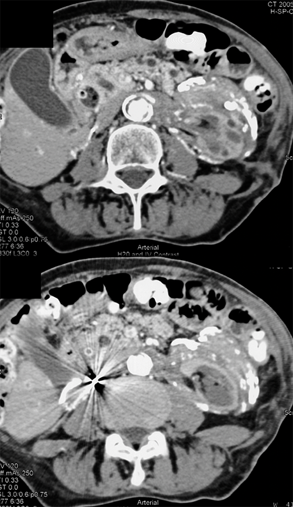 CT of the Perirenal Space